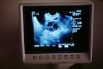 Ultrasound Scan, Ultra-sound, HAFV01P02_02