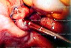 ovary, fallopian tube, HAFV01P02_08