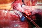 ovary, fallopian tube, HAFV01P02_10