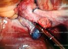 ovary, fallopian tube