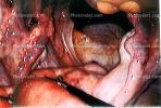 ovary, fallopian tube, HAFV01P02_14
