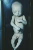 Fetus, Embryo, HAIV01P08_13