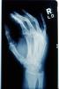 X-Ray, Hand, Carpal Tunnel Syndrome, HASV01P01_17.0143