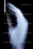 X-Ray, Hand