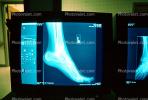 foot, X-Ray, Foot, HASV01P04_04