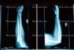 arm, hand, X-Ray, Carpal Tunnel Syndrome, HASV01P04_09