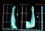 arm, hand, X-Ray, Carpal Tunnel Syndrome, HASV01P04_10