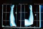 arm, hand, X-Ray, HASV01P04_11