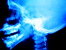 Skull, Teeth, Neck, Chin, X-Ray, HASV01P06_12