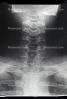 neck, vertebrae, X-Ray, HASV01P06_17.2014