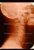 neck, vertebrae, X-Ray, HASV01P06_19.2015