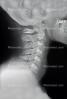 neck, vertebrae, X-Ray, HASV01P07_01.2014