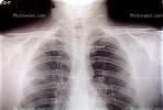 ribs, X-Ray, HASV01P07_08