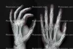 hand, fingers, knuckles, X-Ray, Carpal Tunnel Syndrome, HASV01P08_02.2014