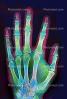 hand, fingers, knuckles, X-Ray, HASV01P08_02D.2014