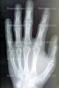 hand, fingers, knuckles, X-Ray, HASV01P08_03