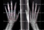 hand, fingers, knuckles, X-Ray, HASV01P08_05.2014