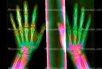 hand, fingers, knuckles, X-Ray, HASV01P08_05B.2014