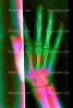 hand, fingers, knuckles, X-Ray, HASV01P08_05D.2014