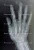 hand, fingers, knuckles, X-Ray, HASV01P08_06