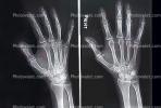 hand, fingers, knuckles, X-Ray, HASV01P08_07.2014