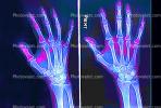 hand, fingers, knuckles, X-Ray, HASV01P08_07B.2014