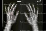 hand, fingers, knuckles, X-Ray, HASV01P08_13.2014