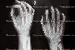 hand, fingers, knuckles, X-Ray, HASV01P08_15.2014