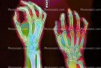 hand, fingers, knuckles, X-Ray, HASV01P08_15B.2014