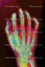 hand, fingers, knuckles, X-Ray, HASV01P08_15D.2014