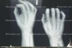 hand, fingers, knuckles, X-Ray, HASV01P08_16
