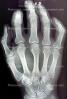 hand, fingers, knuckles, X-Ray, HASV01P08_17