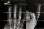 hand, fingers, knuckles, X-Ray, HASV01P09_05.2014
