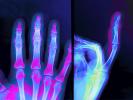 hand, fingers, X-Ray, HASV01P09_05C.2014
