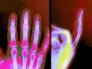 hand, fingers, X-Ray, HASV01P09_05D.2014