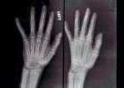 hand, fingers, X-Ray, HASV01P09_08.2015