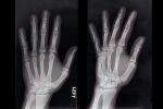 hand, fingers, X-Ray, HASV01P09_09.2015