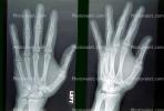 hand, fingers, X-Ray, HASV01P09_10