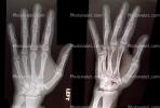 hand, fingers, X-Ray, HASV01P09_11