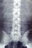 pelvis, back, vertebrae, spine, X-Ray, HASV01P09_12