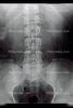 pelvis, back, vertebrae, spine, X-Ray, HASV01P09_13.2014