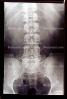 pelvis, back, vertebrae, spine, X-Ray, HASV01P09_13