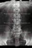 pelvis, back, vertebrae, spine, X-Ray, HASV01P09_15.2014