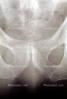 hip socket, pelvis, X-Ray, HASV01P10_01