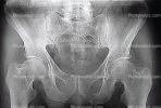hip socket, pelvis, X-Ray, HASV01P10_02.2014