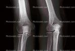 knee, X-Ray, HASV01P10_06.2014
