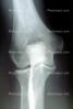 knee, X-Ray, HASV01P10_07