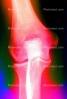 knee, X-Ray, HASV01P10_07B
