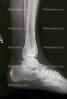 Ankle, leg, foot, X-Ray, HASV01P10_08.2014