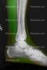 Ankle, leg, foot, X-Ray, HASV01P10_08C.2014